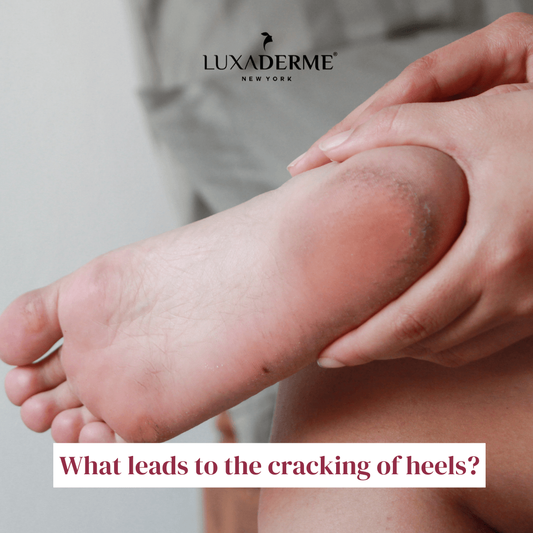 What leads to the cracking of heels? - LuxaDerme