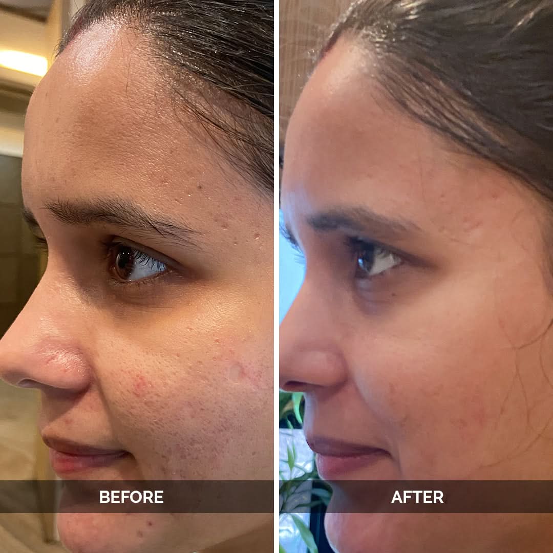 Pore_Perfecting_Serum_5_luxaderme_korean