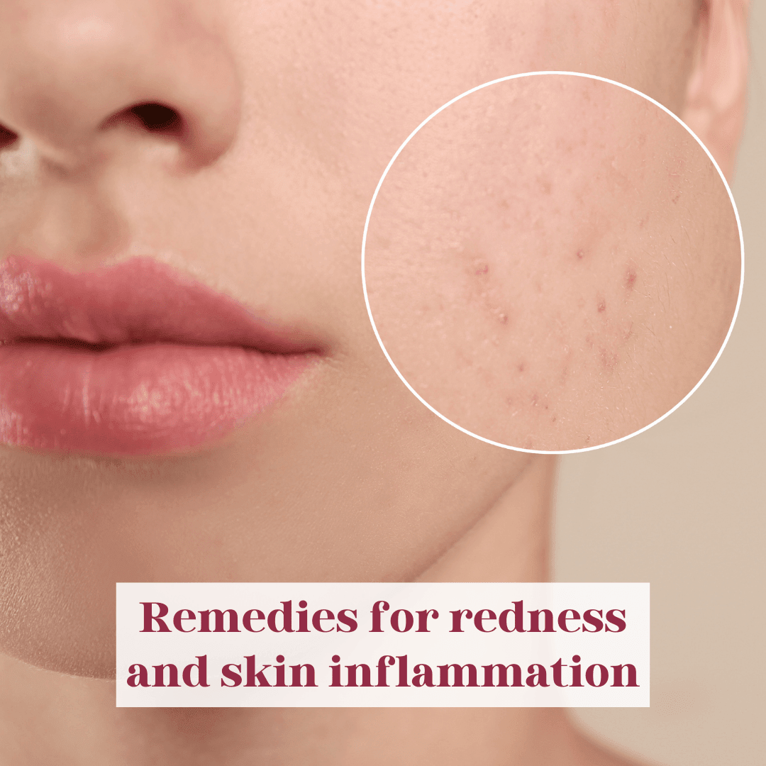 Remedies for redness and skin inflammation - LuxaDerme