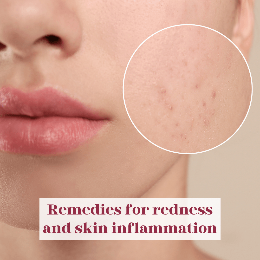 Remedies for redness and skin inflammation - LuxaDerme