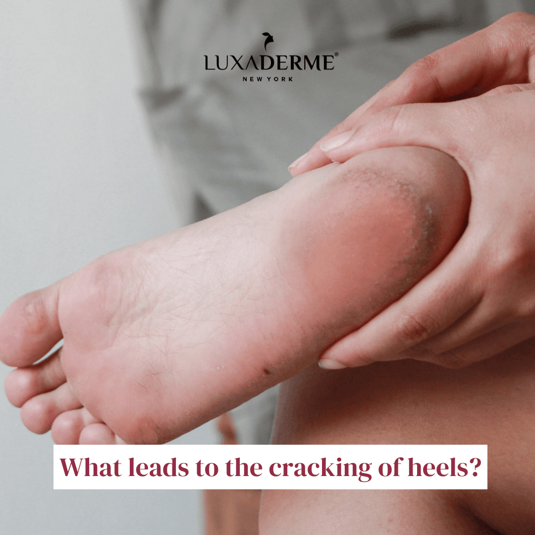 What leads to the cracking of heels? - LuxaDerme